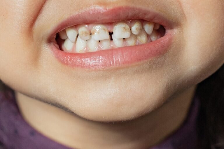 A Little Kashmiri Girl and Her Brown Teeth – Kashmir Observer